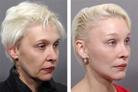 Best Facelift Surgeon | Best Facelift Surgeon in America