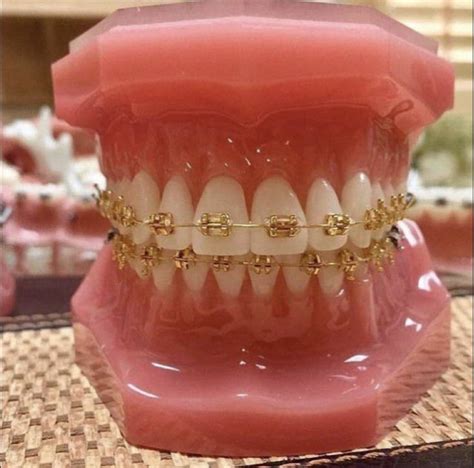 Brattyyace 👅🍬💲 In 2020 Gold Braces Cute Braces Braces Colors