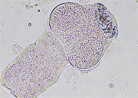 Pathology Outlines Echinococcus