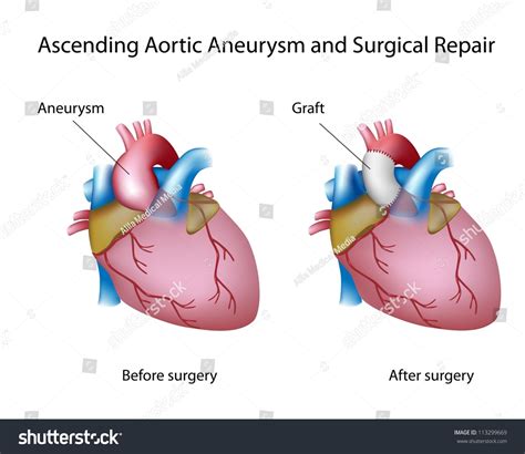 Ascending Aortic Aneurysm Open Surgery Repair Stock Illustration 113299669