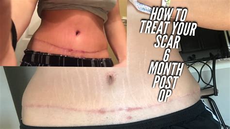 Laser Scar Removal Before And After Tummy Tuck