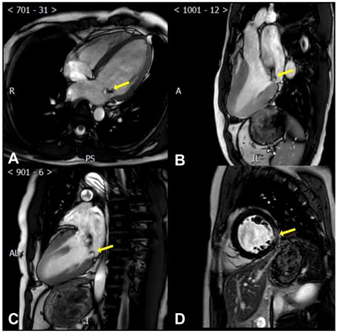 Diagnostics Free Full Text Arrhythmic Mitral Valve Prolapse A