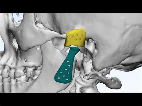 Total Tmj Replacement Surgery Tmj Tmjdisorder Jointreplacement