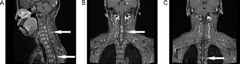 Figure 1 From Primary Lung Adenocarcinoma With Breast Metastasis Harboring The Eml4‑alk Fusion