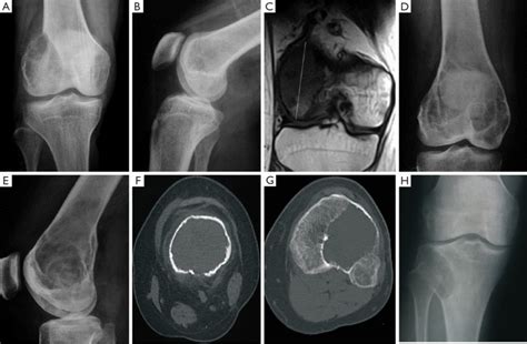 Giant Cell Tumors Of The Bone A E Images Are From 1 Patient Ab