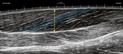 Example Of Extended Fieldofview Ultrasound Image Of Long Head Biceps