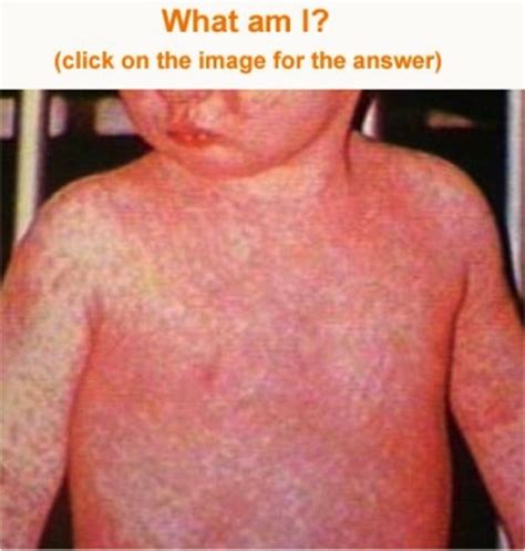 Measles Polio And Virology Flashcards Quizlet