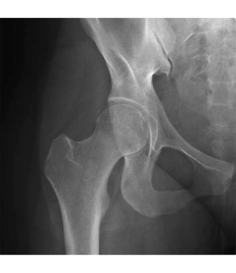 Hip Joint Anteroposterior Radiograph