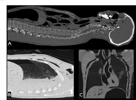 Figure From Differences Between Postmortem Computed Tomography And