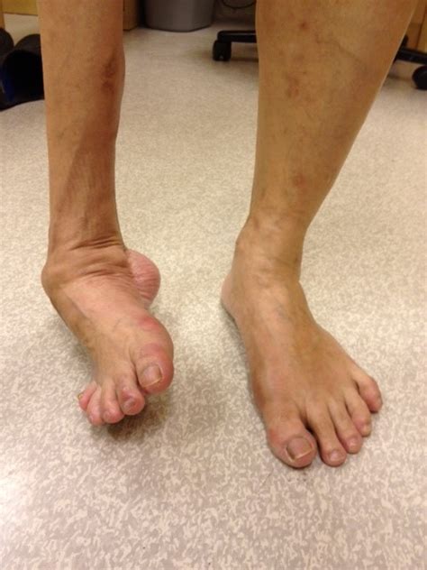 Foot Deformities Singapore|Surgery Reconstruction|Correction