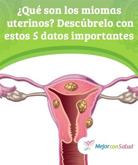 ¿qué Son Los Miomas Uterinos 5 Datos Importantes Miomas Uterinos Miomas Uterinos Remedios