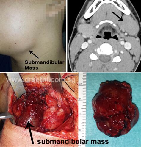 Submandibular Masses Dr Dharambir S Sethi