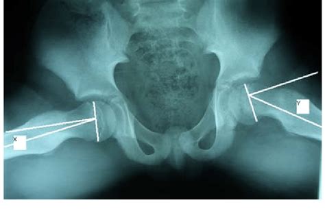 Lateral Frog Radiograph Demonstrating The Measurement Of The Lateral