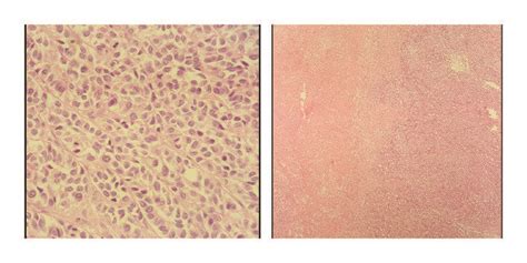 Microscopic Images Of Malignant Histiocytic Tumor And Its Necrosis Area