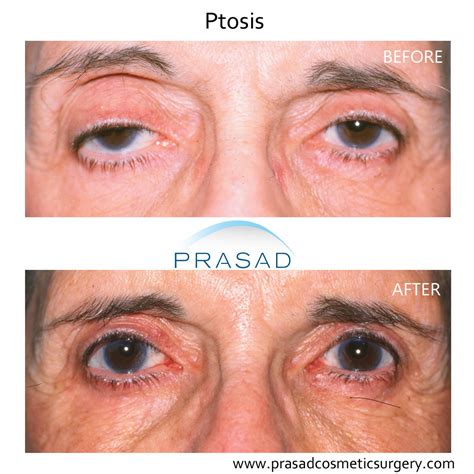 Ptosis Surgery Before And After Types Cost Risks Recovery