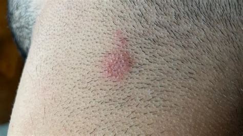 Estos Son Los Síntomas De La Tiña Según Alertan Los Dermatólogos Onda Cero Radio