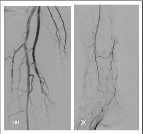 Figure 1 From A Noval Approach Using Angioplasty For Recanalization Of