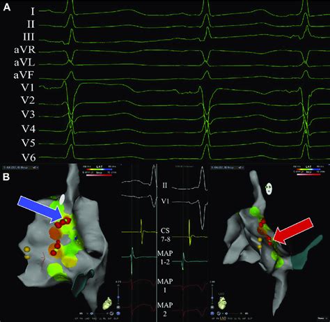 Intraprocedural Surface Electrocardiogram And Electroanatomic Mapping