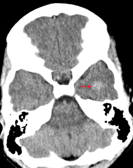 Pearls And Pitfalls Of Pediatric Head Trauma Imaging Applied Radiology