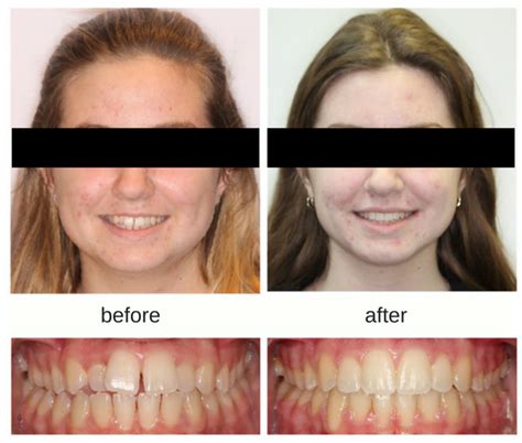 Teen Invisalign And Braces Before And After Hometown Orthodontics