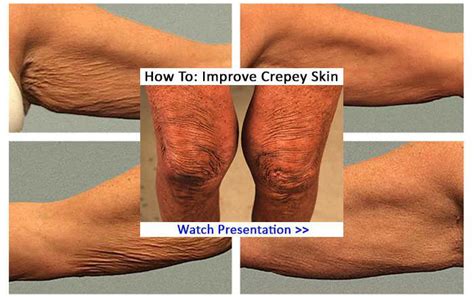 My Crepey Skin Remedies - Natural treatments to help get rid of crepey ...