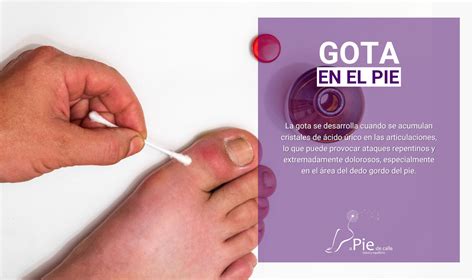 Gota En El Pie Dolor Y Tratamiento