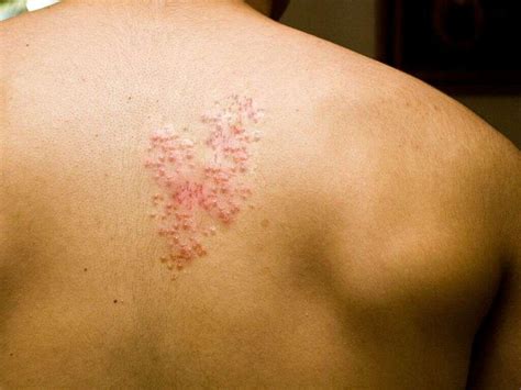 Shingles Symptoms Diagram