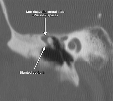 Interactive Web Based Learning Module On Ct Of The Temporal Bone