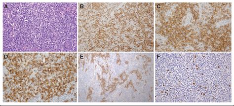 Figure 2 From Histologic Transformation Of Epstein Barr Virus Positive