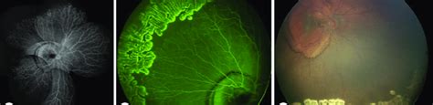 Fa Of The Right Eye Demonstrating Subretinal Lesion In The Posterior Download Scientific