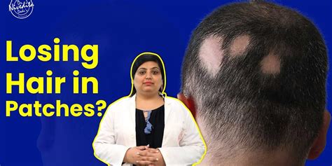 Alopecia Areata: Causes, Symptoms & Treatments | Explained by Dr ...