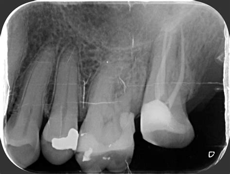 Radiografía Periapical Radiograf