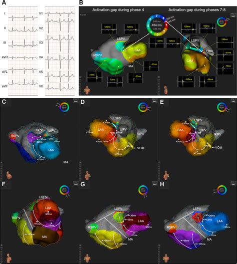 A Twelve Lead Electrocardiogram During The Clinical Atrial Tachycardia