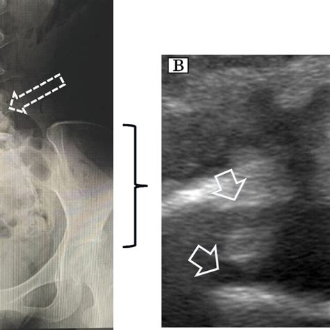 A Radiographical Image Of The Lumbar Spine On AP View The Solid Arrow