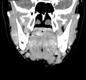 Odontogenic Cutaneous Fistula Radiology Reference Article