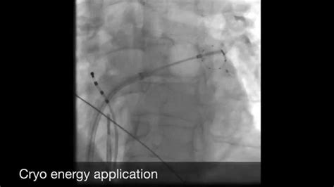 Atrial Fibrillation Ablation Using Cryo Balloon Youtube