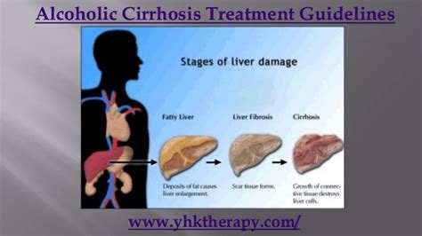 Alcoholic cirrhosis treatment guidelines