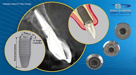 Southern Implants Dental Implant Treatment Solutions Innovative