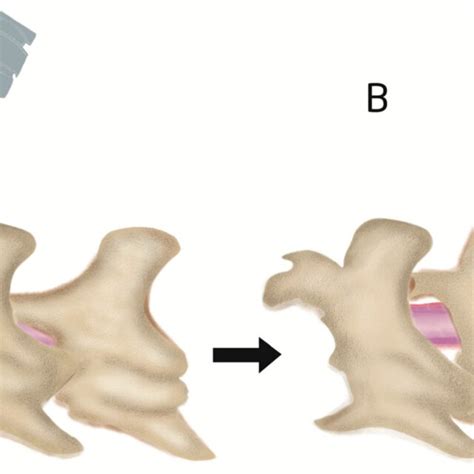 Illustration of intraspinal intrathecal injection site and angle. First ...