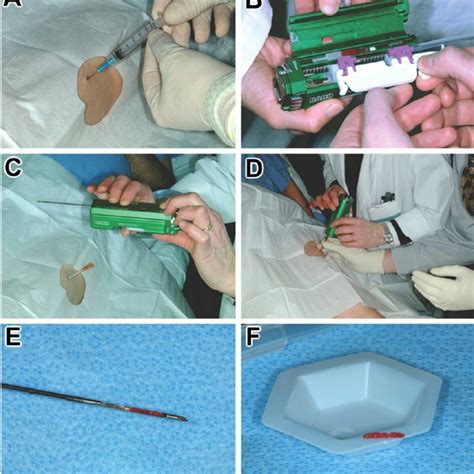 PDF Percutaneous Muscle Biopsy History Methods And Acceptability