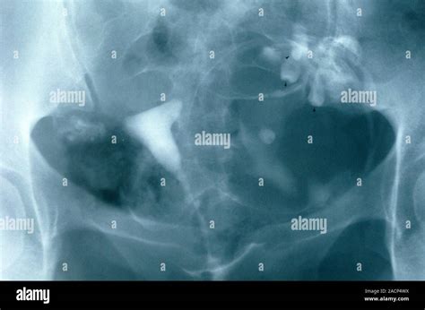 Ovarian Dermoid Cyst Coloured Hysterosalpingogram X Ray Of The Pelvis