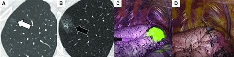 A Representative Case Of Indocyanine Green Virtual Assisted Ling