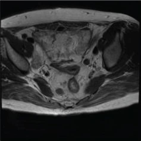 A 63 Year Old Woman With Rectal Cancer Histopathologically Diagnosed As Download Scientific