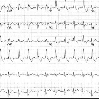 C 12 Lead EKG Of Same Patient Showing Sinus Rhythm Complete Right