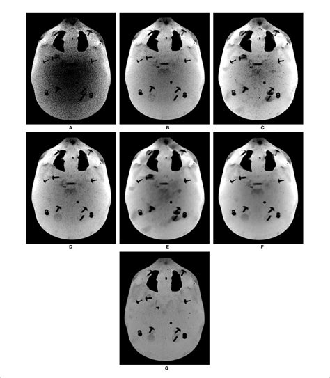 Comparison Of Minimum Intensity Projections Minips Of Cbct Images