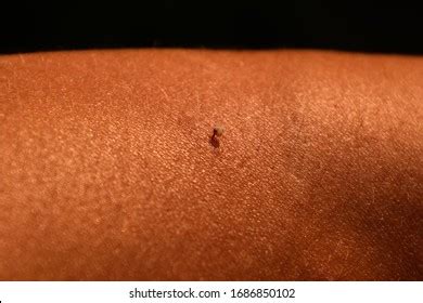 Bee Sting Bee Sting Human Skin Stock Photo 1686850102 | Shutterstock