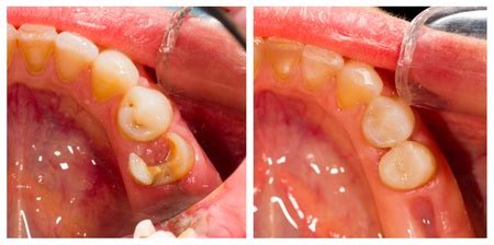 Amalgam Fillings vs. Resin Composite Fillings - Danville Family Dentistry