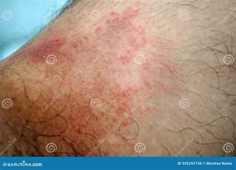 Itchy Rash In The Groin Area Tinea Cruris Is A Type Of Skin Disease