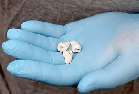 What To Expect When Getting Your Wisdom Tooth Removed