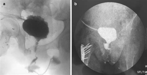 Post Operative Voiding Cystourethrography Showed Good Continuity Of